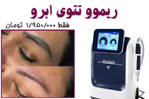 tatooremove