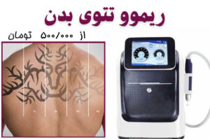 tatooremove2