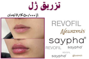 تزریق ژل