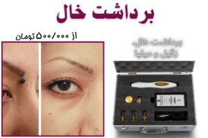خال 1